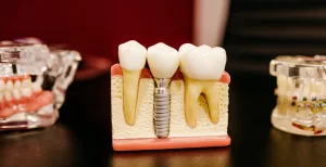 implant dentar cluj