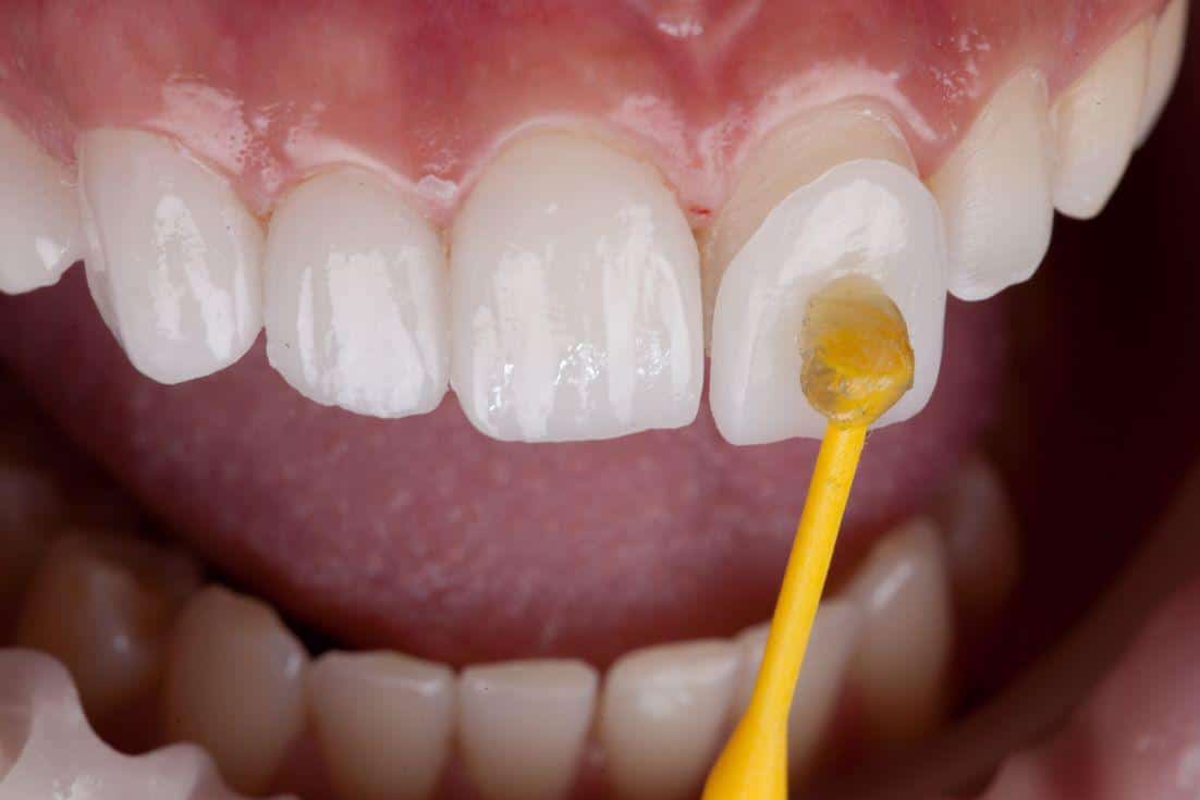 fatete dentare cluj pret